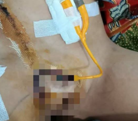 Korban Malpraktek, Bocah di Kayu Aro Alami Putus Kelamin Usai Sunat Laser